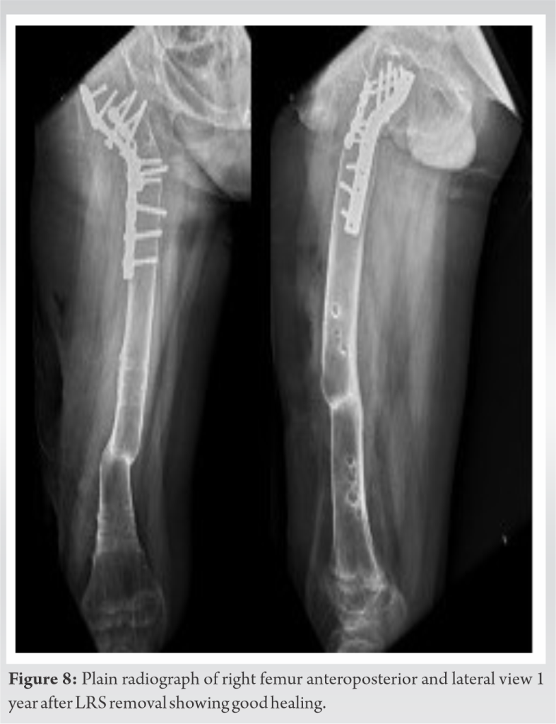 Subacute Bacterial Infection Mimicking A Slipped Capital Femoral