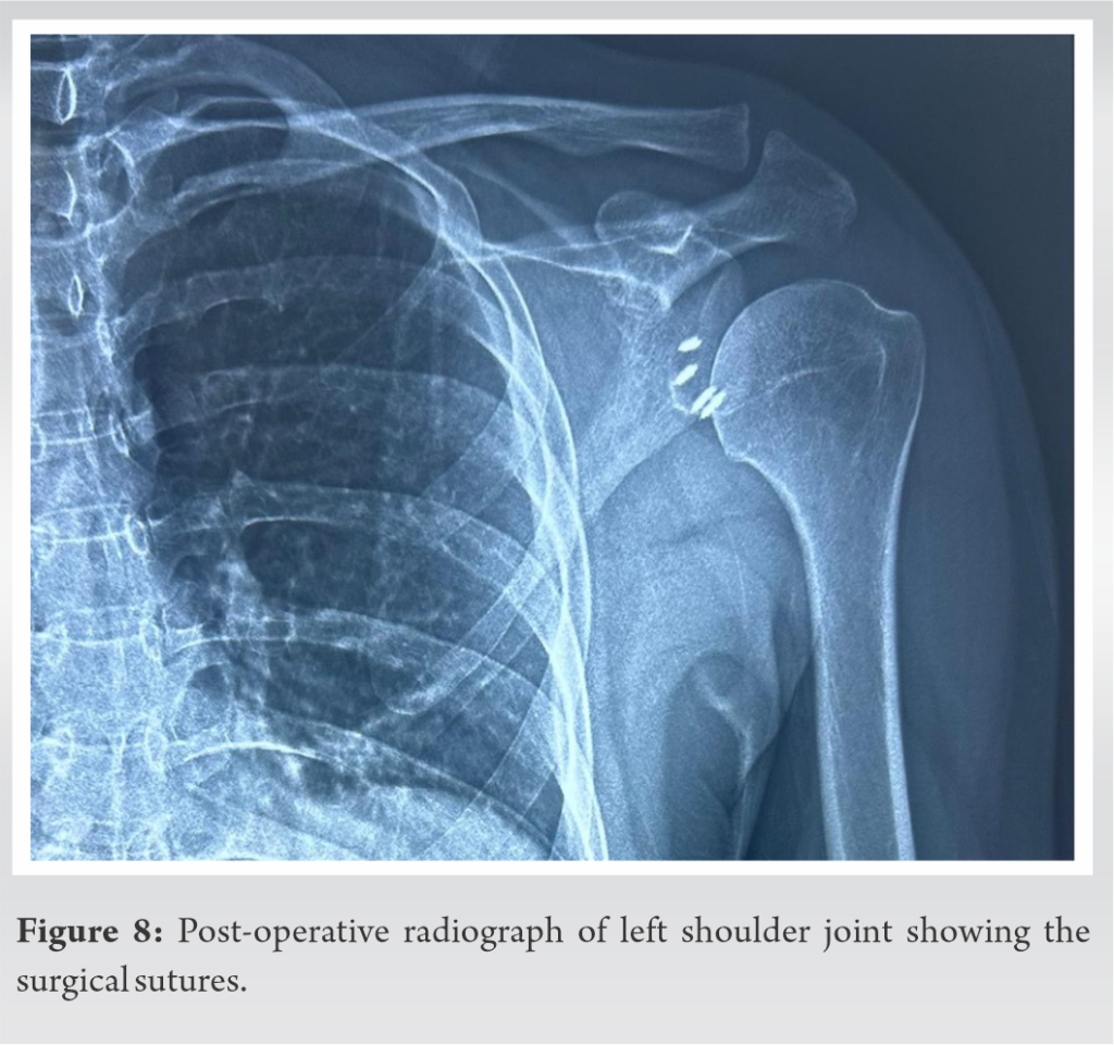 Comprehensive Evaluation and Arthroscopic Management of Circumferential ...