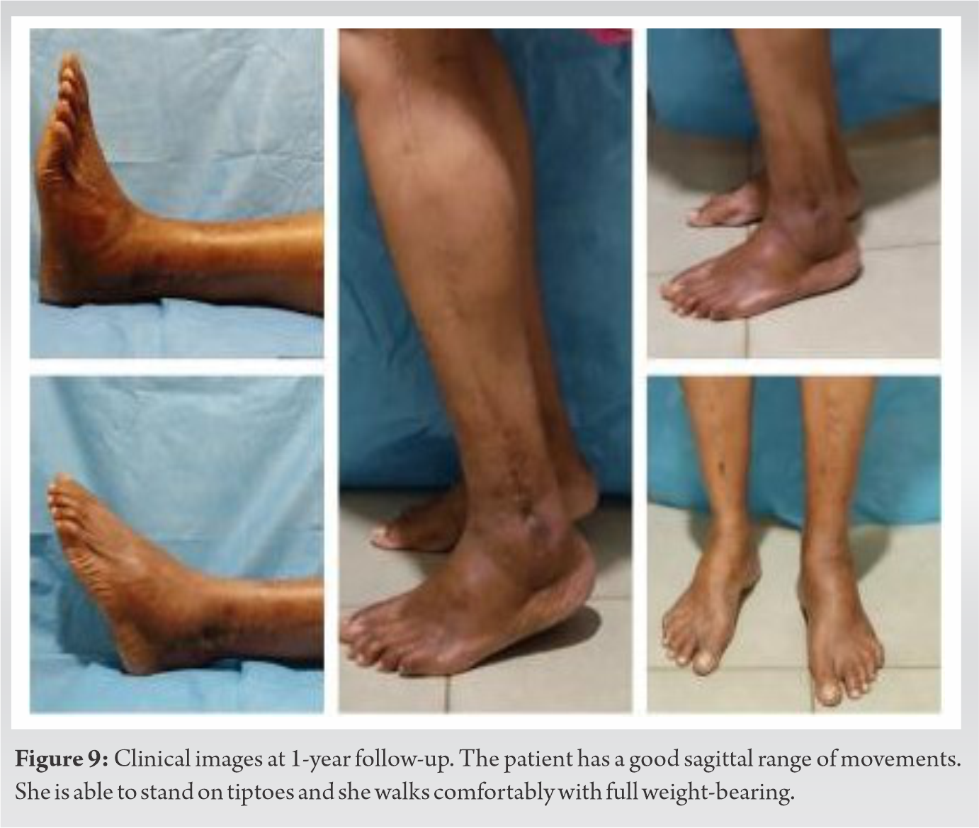 Periosteal Osteosarcoma of the Distal Shaft of Fibula: Case Report on ...