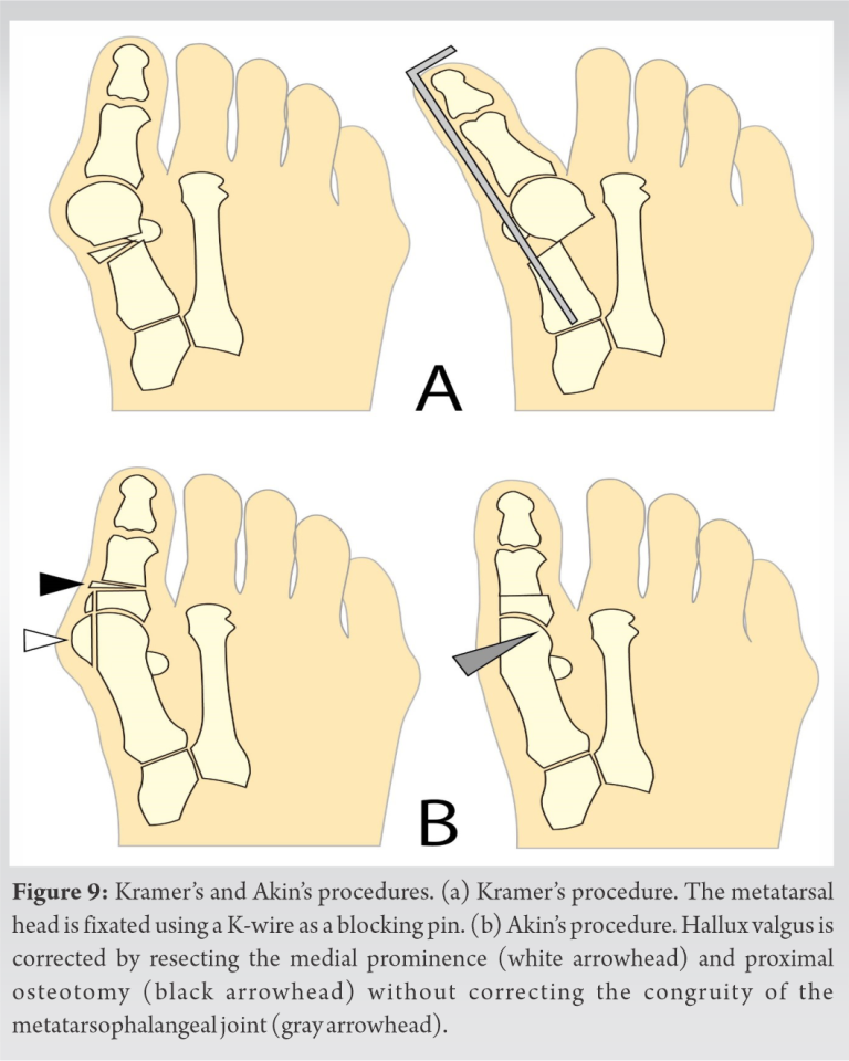 Distal Metatarsal and Proximal Phalangeal Osteotomies without Soft ...