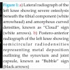 Metallosis Presenting as Knee Pain 26 years after Primary Total Knee Arthroplasty