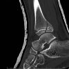 Triplane Ankle Fracture with Concomitant Ipsilateral Shaft of Tibia Fracture: Case Report and Review of Literature
