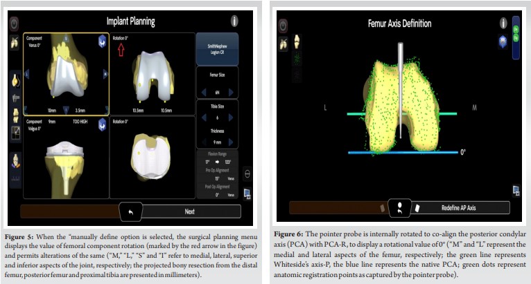Femoral Component Rotation Precise Calibration of Femoral Component Rotation Using the Posterior ...