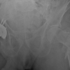 “The Wayward Screw”: A Rare Case Report of Intrapelvic Migration of a Cephalomedullary Lag Screw
