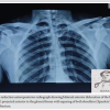 Simultaneous Bilateral Anterior Shoulder Dislocation Following Epileptic Seizure in a Middle-Aged Male: A Rare Case Report and Review of Literature