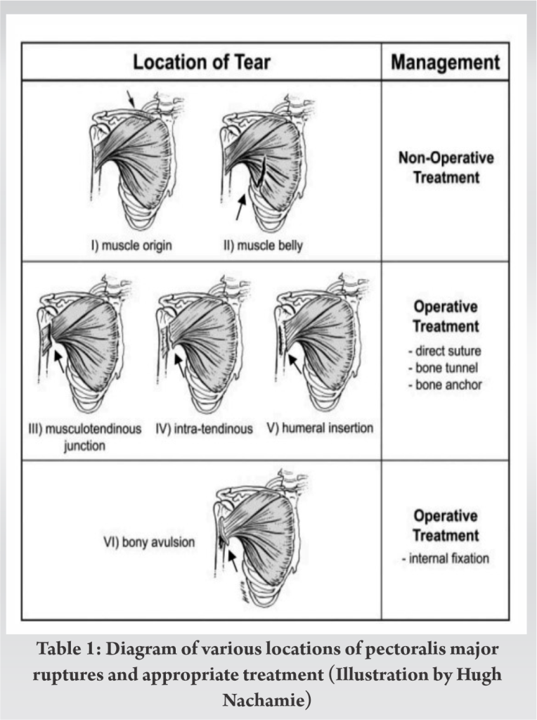 Chronic Rupture Of Pectoralis Major Muscle Repair A Surgical Case Report Journal Of 5841