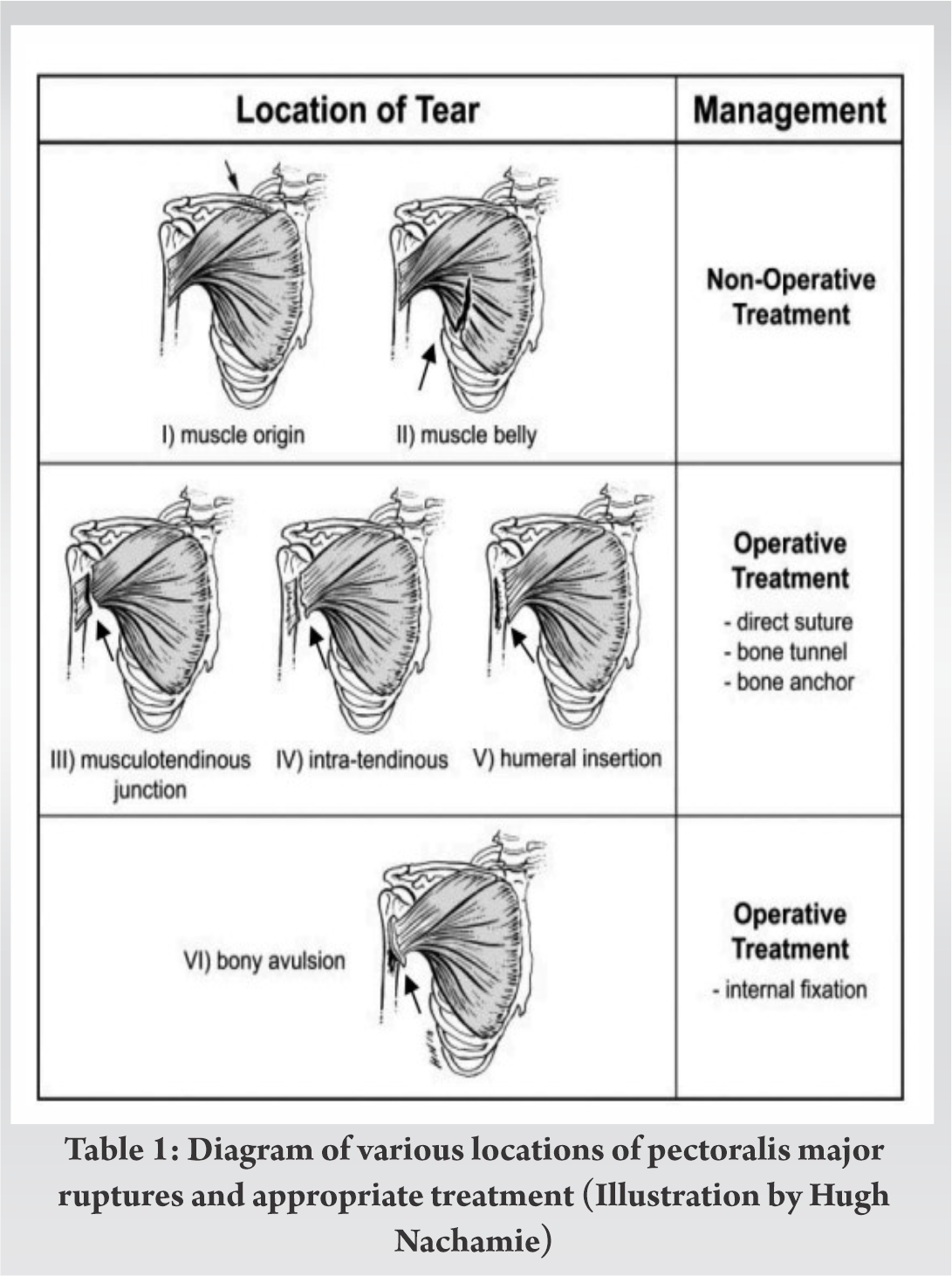 Chronic Rupture Of Pectoralis Major Muscle Repair A Surgical Case Report Journal Of 8238