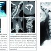 Hyperplasia of Lamina and Spinous Process of C5 Vertebrae and Associated Hemivertebra at C4 Level