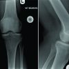 Leiomyosarcoma of the Lower Limb Presenting as a Benign Mass: A Case Report