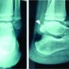 Combined Anterior and Posterior Ankle Arthroscopy for Dysplasia Epiphysealis Hemimelica of the Ankle in a Child: A Case Report