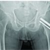 Surgical Fixation of Subtrochanteric Fracture in Patient with Cancellous Screw Fixation for Neck of Femur Fracture: Surgical Decision-Making and Outcome