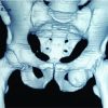 Obturator Dislocation of Hip with Ipsilateral Fracture Neck Femur-A Case Report