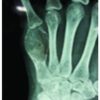 Giant-cell Tumor of Metacarpal in the Skeletally Immature Patient and Free Osteoarticular Metatarsal Transfer: Review of Literature with Case Report