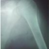 Atypical Osteonecrosis of Humeral Head FollowingAnterior Shoulder Dislocation