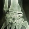 Proximal Row Carpectomy with Resurfacing Capitate Pyrocarbon Implant with Bone Graft for Scaphoid Nonunion Advanced Collapse III Wrist with Total Intramedullary Bone Resorption of the Capitate: A Case Report