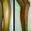 Fasciitis and Streptococcal Toxic-shock Syndrome: The Importance of Early Diagnosis and Surgical Management