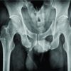 Bilateral Anterior Column Acetabulum Fracture following Road Traffic Accident: A Rare Presentation