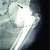 An Unusual Central Dislocation of a Total Hip Arthroplasty Due to Severe Wear of a Ceramic on Cross-linked Polyethylene Bearing Coupling – A Case Report