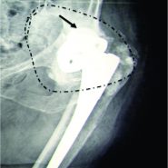 Highly Cross Linked Polyethylene In Total Hip Arthroplasty In Patients Younger Than 50 Years With Osteonecrosis Of The Femoral Head A Minimum Of 10 Years Of Follow Up The Journal Of Arthroplasty