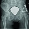 Lollipop Sign – Ossification at Wire Ends after Osteosynthesis?