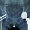 Unusual Bilateral Neck of Femur Stress Fracture in a Healthy, Non-athletic Individual – ACase Report and Literature Review