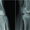 Reverse Segond Fracture without Posterior Cruciate Ligament Injury – A report of Two Cases and Review of the Literature