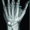 Acute Traumatic Pseudo-pointing Index Finger Due to an Isolated Second Metacarpal-Trapezoid Dislocation: A Case Report
