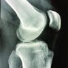 Partial Denervation for Neuroma Pain after Knee Anterior Tibial Tuberosity Exostectomy: A Case Report