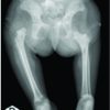 Bilateral Congenital Absence of Femur: A Rare Case Report
