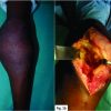 Synovial Lipomatosis with Chondroblastoma in an 8-year-old Female: A Previously Unreported Entity