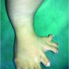 Mirror foot with Trapezoidal dysplastic Tibia– A Case Report
