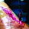 Closed Rupture of Anterior Tibialis Tendon after Minor Injury without Medical History: ASurgical Repair