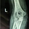 Treatment of Chronic Simple Elbow Dislocation by Two Separate Incisions – A Case Report