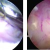 Mucoid Degeneration of the Anterior Cruciate Ligament: A Case Report and Review of Literature