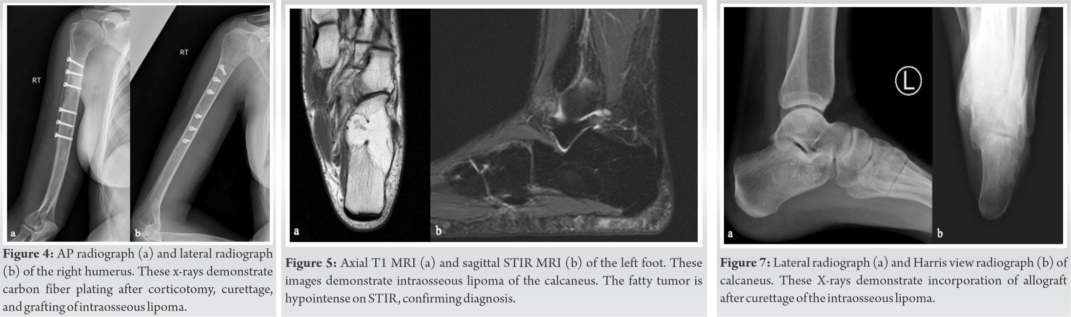 Fig 4 5 6 Journal Of Orthopaedic Case Reports